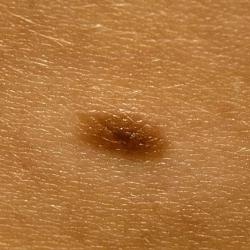 Example of moleRemoval